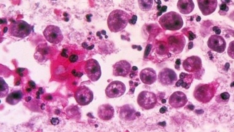 Caso de ameba "come cerebros" provoca emisión de alerta en Florida