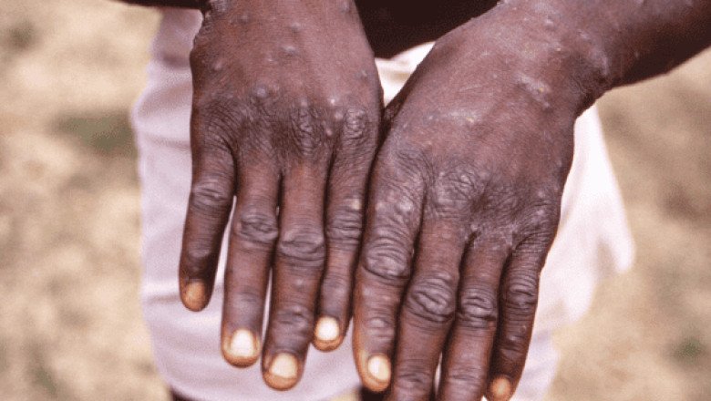 El virus que ha causado cientos de muertes en el Congo