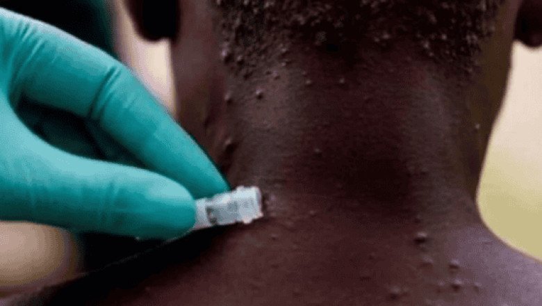 Kenia registra su primer caso mpox, antes viruela del mono