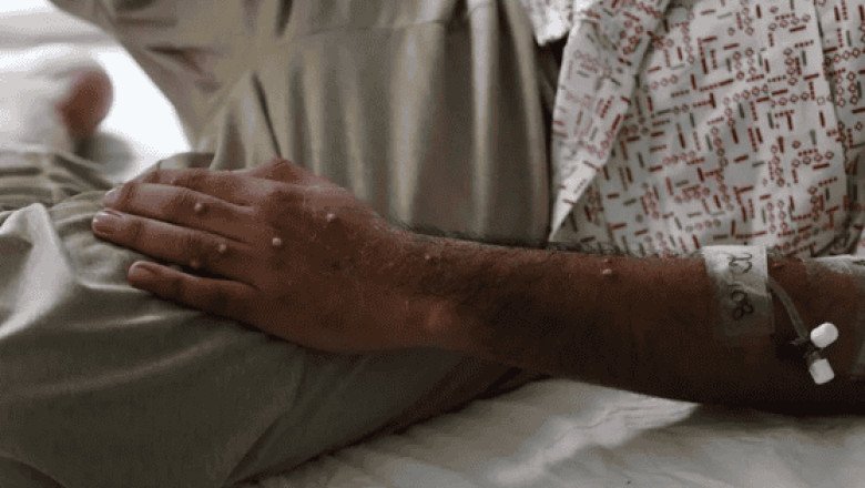 Este es el plan de la OMS para atender la mpox