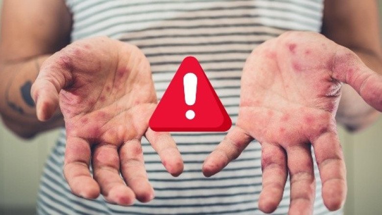 Comité de Vigilancia lanza aviso epidemiológico por sarampión
