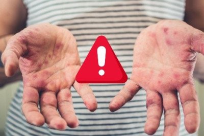 Comité de Vigilancia lanza aviso epidemiológico por sarampión