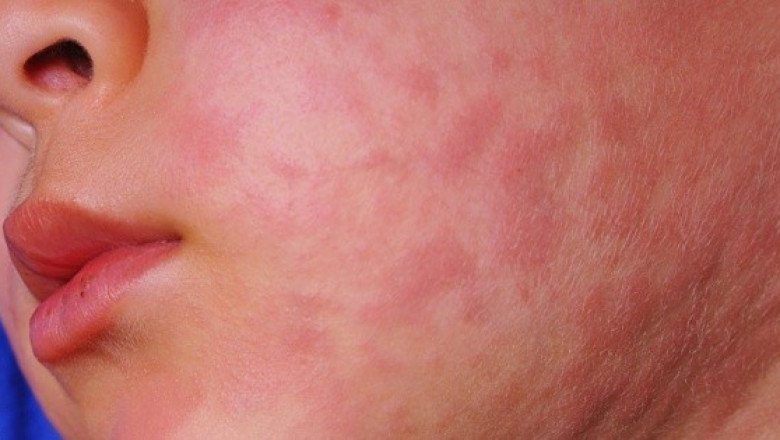 Hidalgo implementa medidas por sarampión en tres municipios