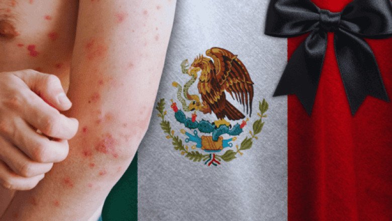 ¿Cuántos muertos van en México por sarampión hasta HOY?