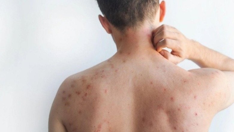 ¿Qué hacer para reducir los síntomas de sarampión?