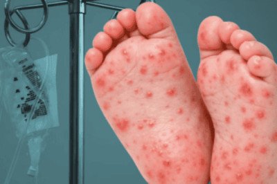 Registran primera muerte por sarampión en Guerrero